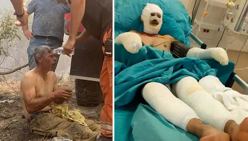 Orman İşçisinin "Yanıyorum" Feryadı: Tedavi Süreci ve Detaylar
